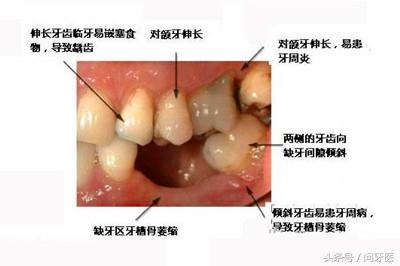 门牙有缺失的在相学上有什么说法_耳垂折痕的相学说法_上门牙缝隙很大说法