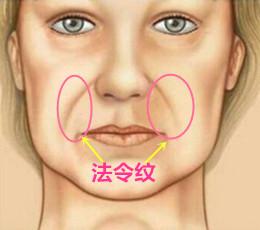 面相法令纹图解_玻尿酸填充去法令纹好还是自体脂肪填充去法令纹好_好的法令纹面相图解