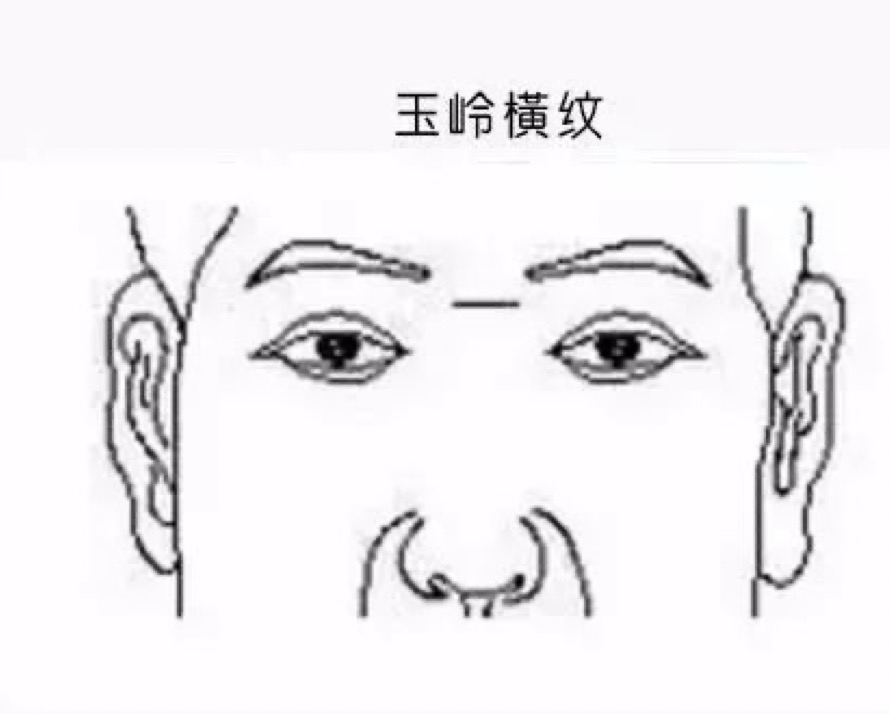 面相中的阴德纹照片_人体阴鹜纹面相图解_面部阴骘纹